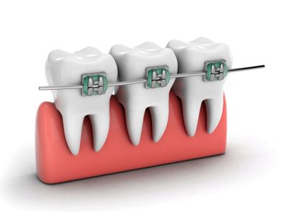 Dental Braces treatment in Kurnool