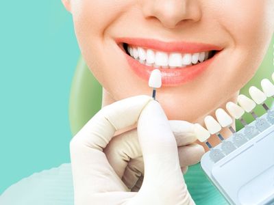 Dental Veneers treatment in Kurnool