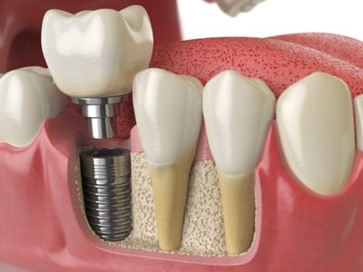 dental implants in kurnool